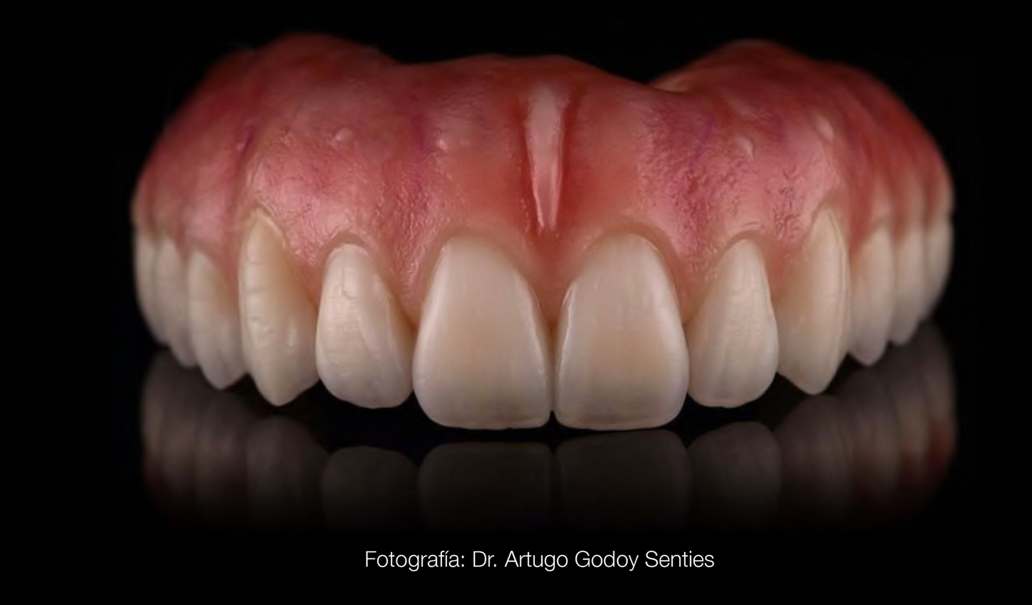 Coronas de Zirconio