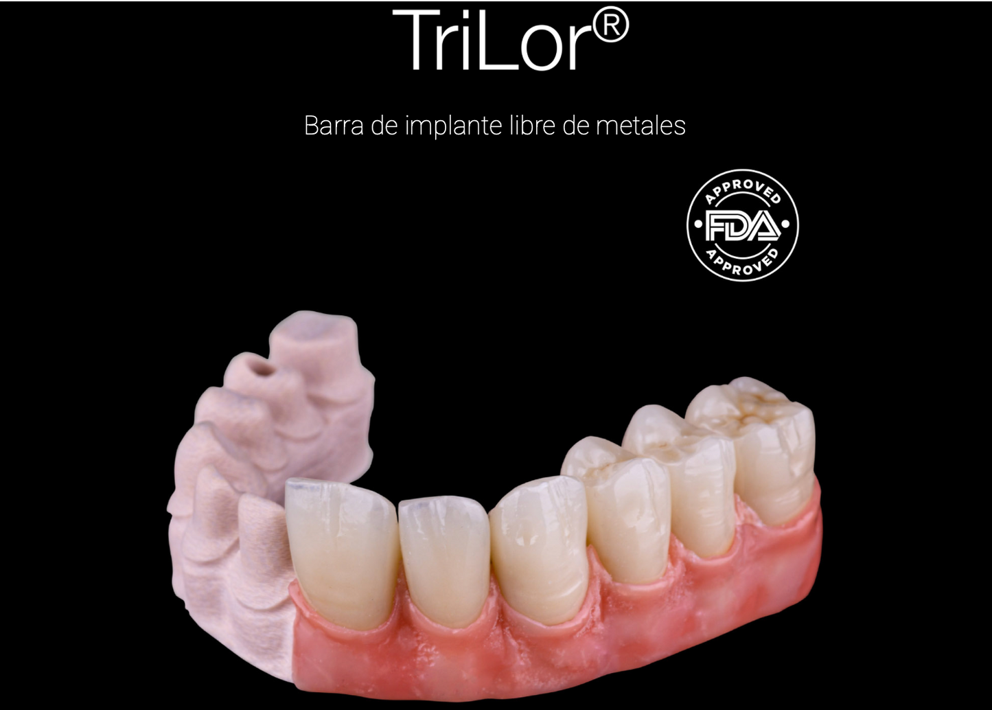 Barra sobre implantes Trilor